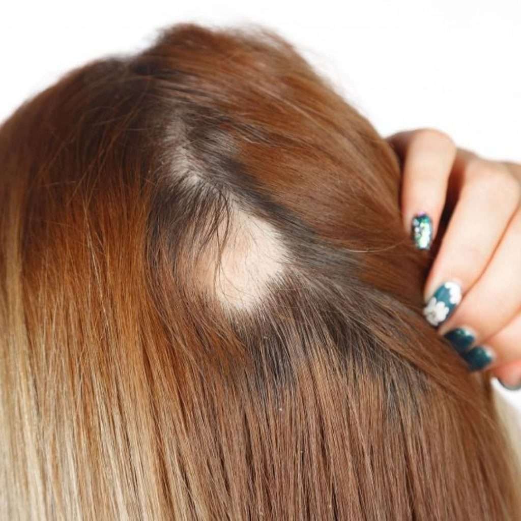 Exosomes Hair Treatments