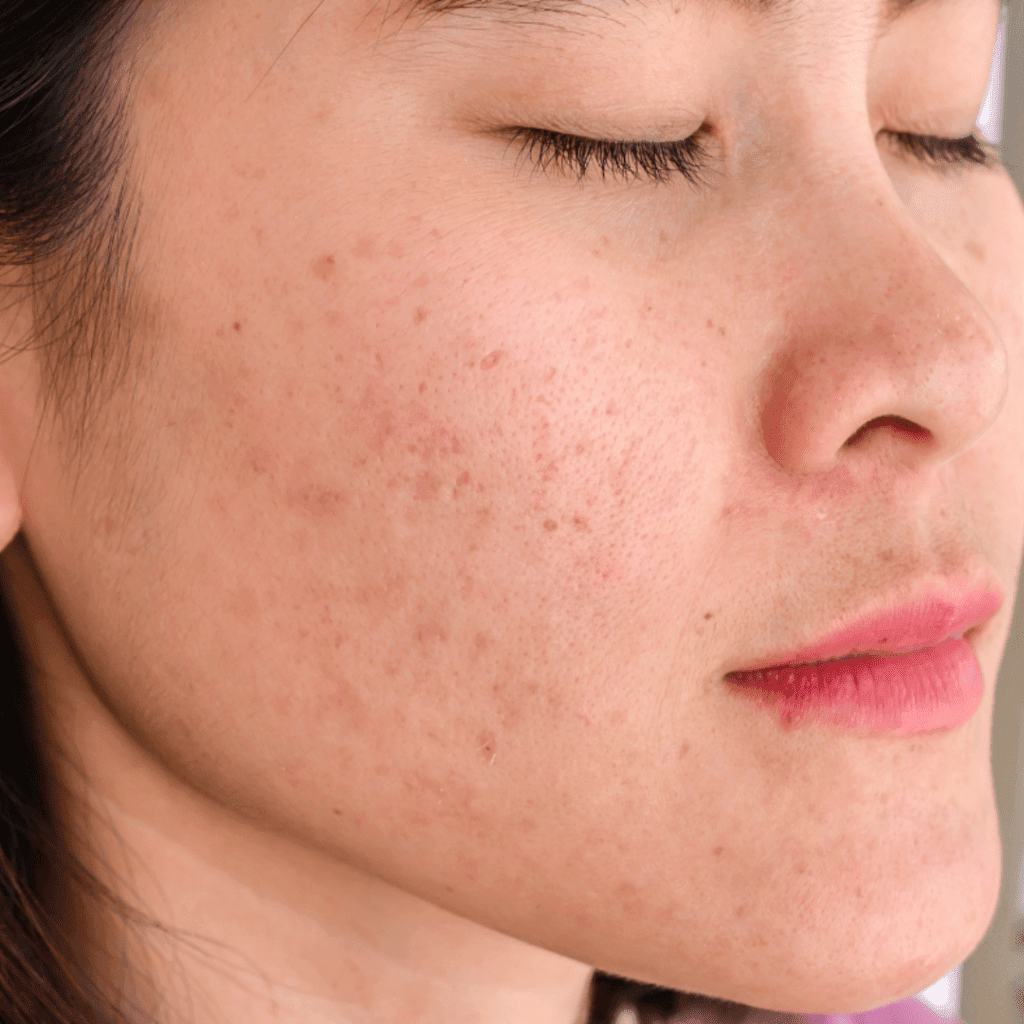 Congested Pores on women face Hydrafacial Treatment