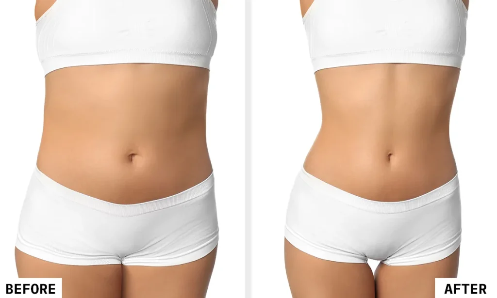 Best Weight Loss Treatment before and after