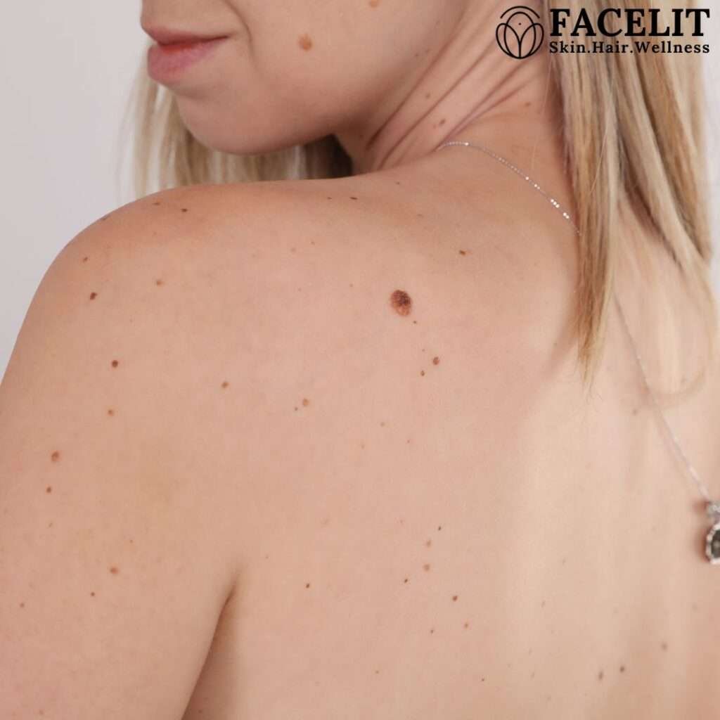 Best Skin Tag and Tan Removal in Trivandrum