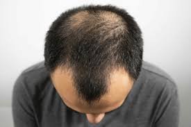men facing hair loss