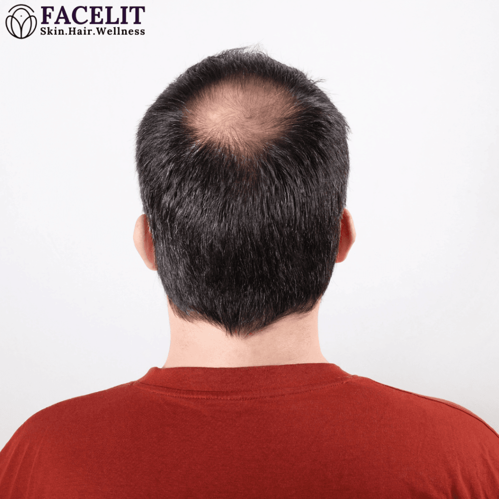 Best Hair Clinic in Bangalore