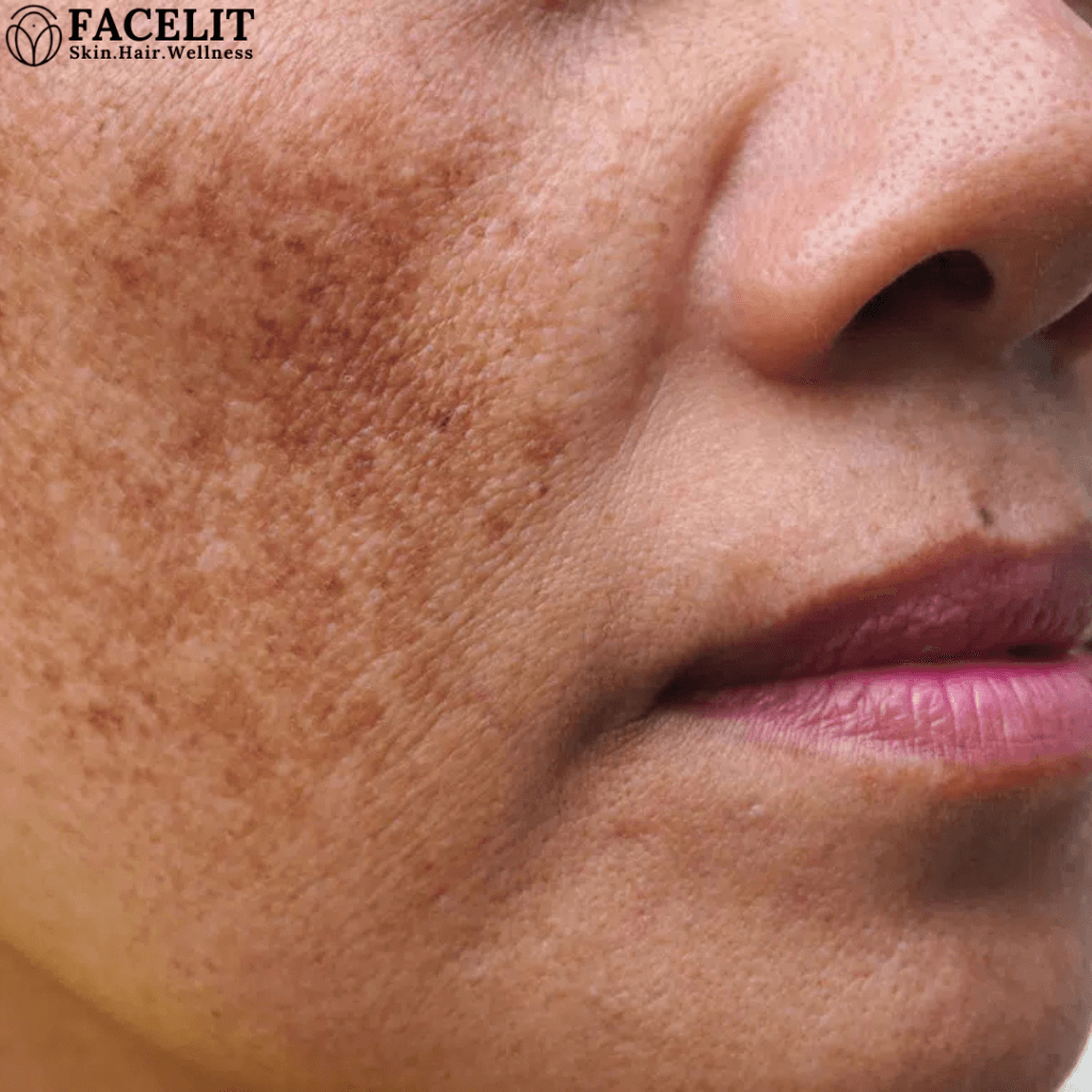 How to Reduce Pigmentation on the Face