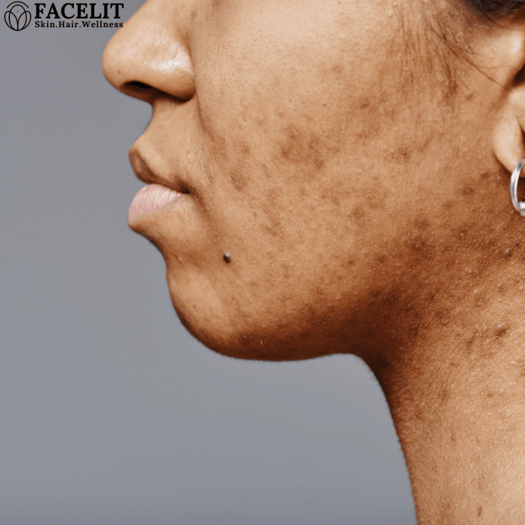 How to remove black marks on face quickly