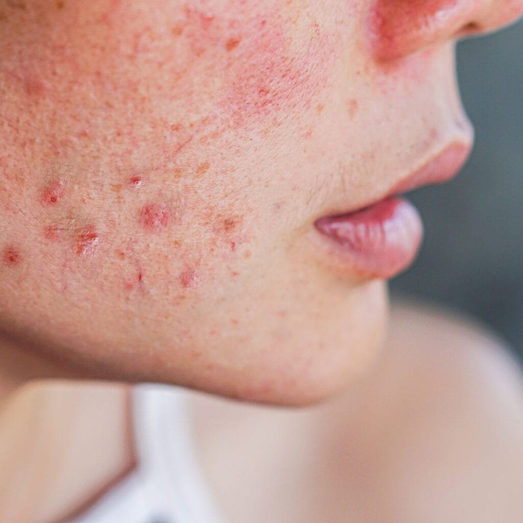 Exosomes Skin Treatment