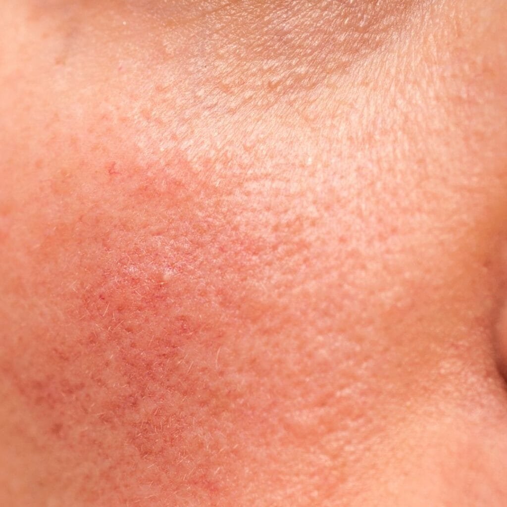 exosomes skin treatment done at facelit clinic