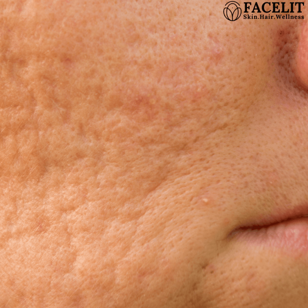 How to Get Rid of Large Pores