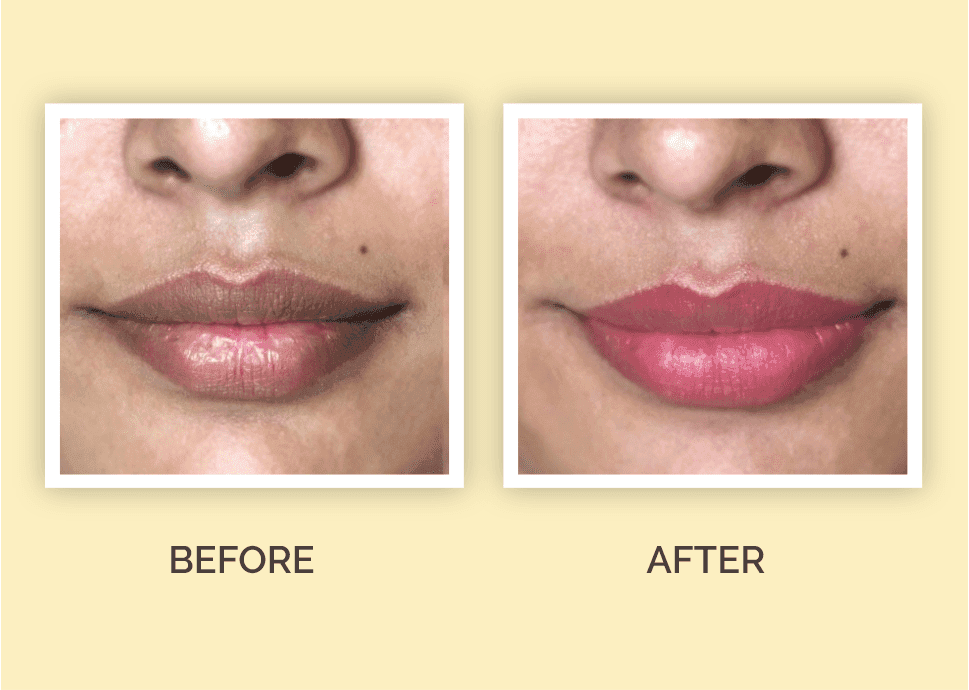 dark lip treatment done at facelit clinic and before and after