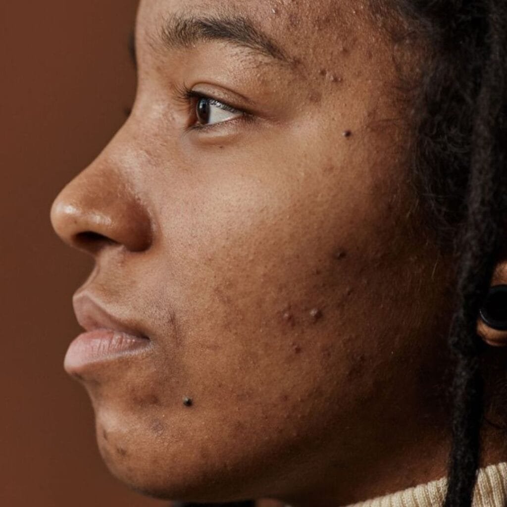 Fade acne scars on dark skin