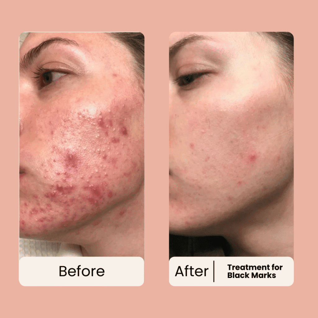 before and after for Acne Scars on face