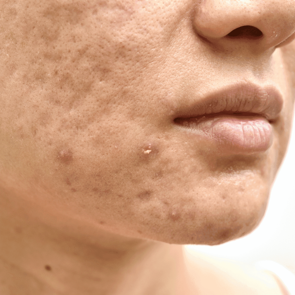 best co2 treatment done at facelit clinic