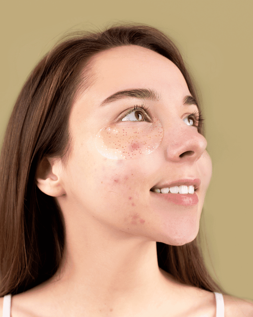Acne Scar Treatment in Trivandrum