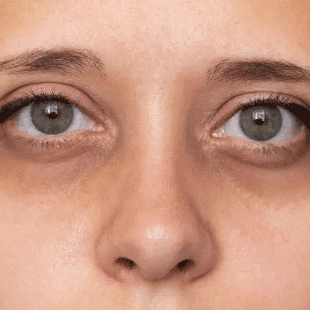 Under Eye Dark Circle Treatment in Kalyan Nagar